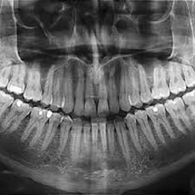 Dental Panoramic X-Ray in Dubai