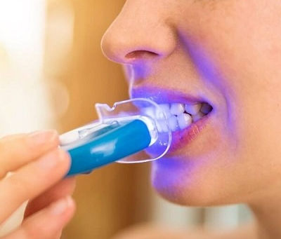 How Often Can You Repeat Zoom Teeth Whitening Treatments?