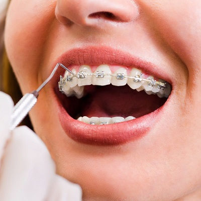Metal Braces in Dubai