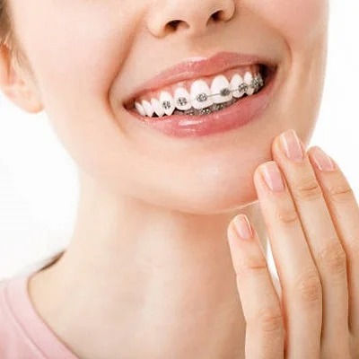 Dental Braces Dubai