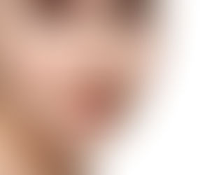 What to Expect After Eyelid Surgery: Before and After Results