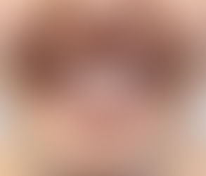 Can Crowded Teeth Treatment Improve Your Smile?