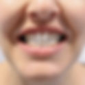 Can Crowded Teeth Treatment Improve Your Smile?