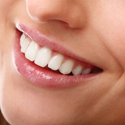 Hollywood Smile Design Dubai