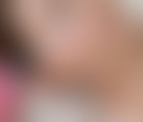 حشوات ريستيلان لتجديد منطقة تحت العين