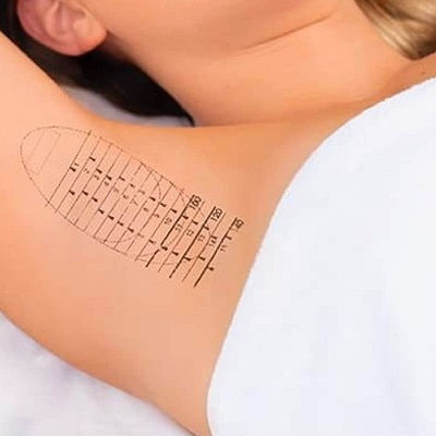 Best Hyperhidrosis Treatment Oman
