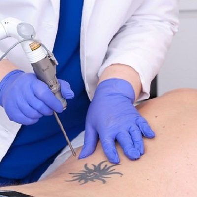 Best Laser Tattoo Removal in Muscat