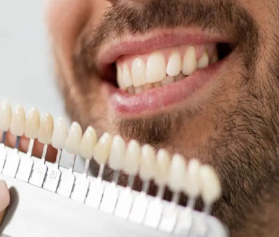 Is the E-max Veneer Procedure Painful? What Dubai Patients Should Expect