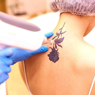 Best Laser Tattoo Removal in Oman