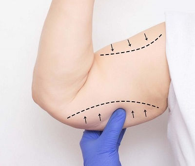 ما هي عملية شد الذراع وكيف تعمل؟