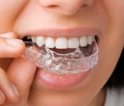 Can Retainers Fix Uneven Teeth?
