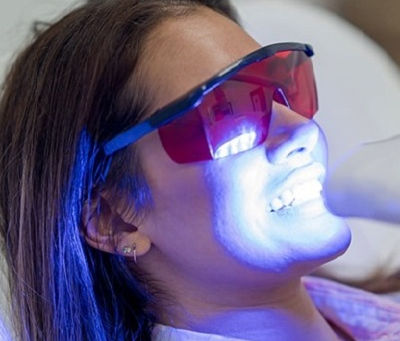 Understanding the Different Teeth Whitening Options Available in Dubai