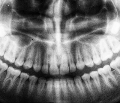 Dental Panoramic X-Ray: What It Reveals About Your Teeth