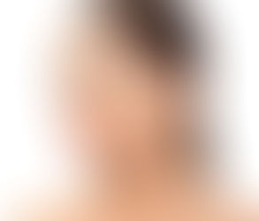 نحت الجسم بعد جراحة إنقاص الوزن