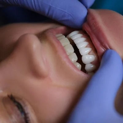 Composite Veneers in Dubai