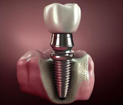 Long-Term Maintenance of Dental Implants