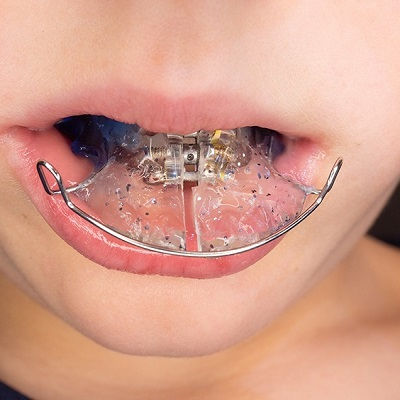 Dental Appliances in Dubai