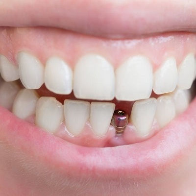 Dental Implants in Duabi