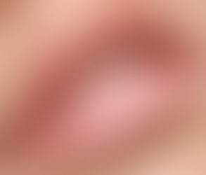 What Is the Ideal Lip Shape After Getting Lip Filler Injections?