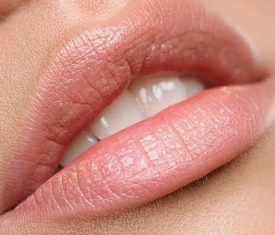 What Is the Ideal Lip Shape After Getting Lip Filler Injections?