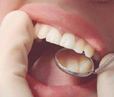 The Impact of Composite Fillings on Your Dental Health in Dubai