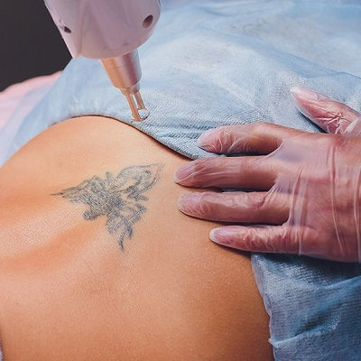 Best Laser Tattoo Removal in Muscat