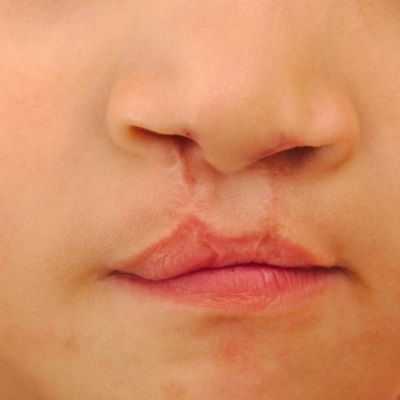 Palate Repair Surgery in Muscat