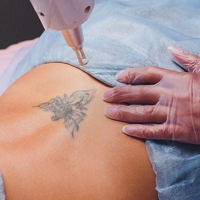 Laser Tattoo Removal Oman