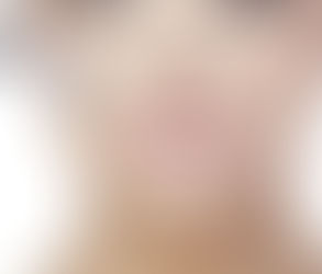 The Benefits of JUVÉDERM Voluma for Facial Contouring