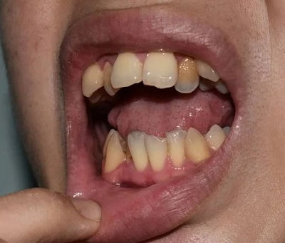 Managing Overlapping Teeth in Dubai: What Are the Risks?