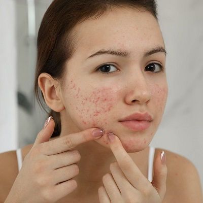 Acne Scar Treatment Oman