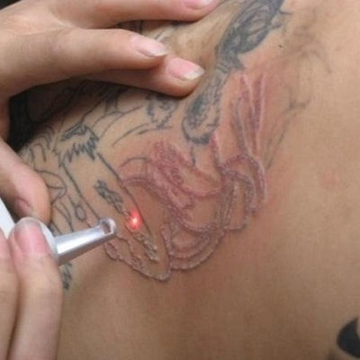 Laser Tattoo Removal Oman