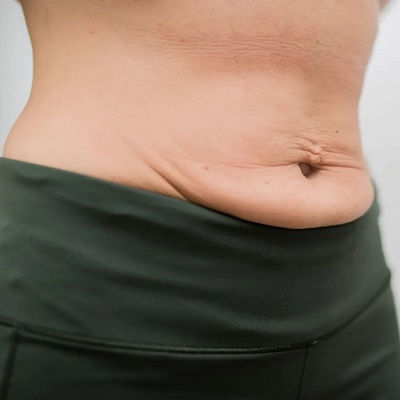 Best Post Weight Loss in Oman
