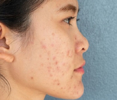 The Science Behind Acne Scar Formation