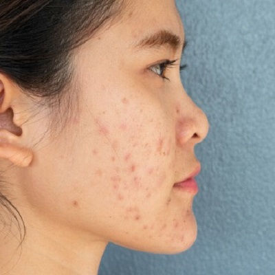 Acne Scar Treatment in Muscat