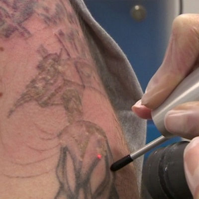 Laser Tattoo Removal Oman