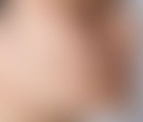 Laser vs. Dermabrasion: Which is Better for Acne Scars?