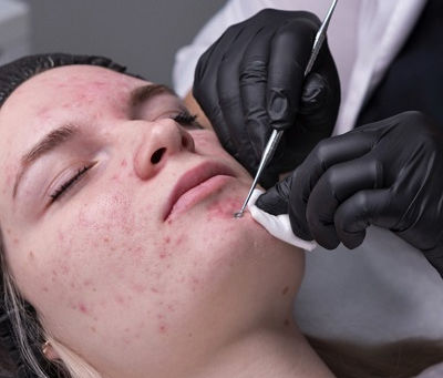 الدليل الأمثل لعلاج حب الشباب للحصول على بشرة صافية