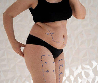 كيفية الحفاظ على نتائج شفط الدهون على المدى الطويل