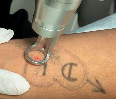 Can Laser Tattoo Removal Be Used for Microblading?