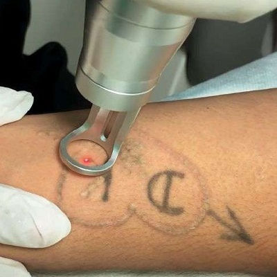 Laser Tattoo Removal in Oman