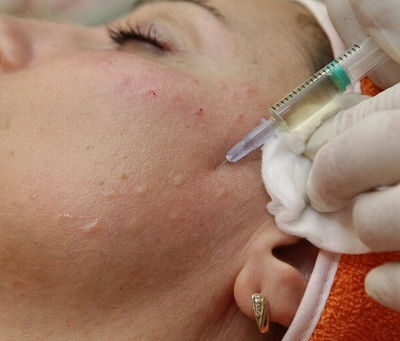 Can Hyalift Injections Be Used on the Body?