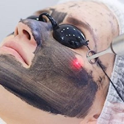 Laser Carbon Peel Muscat