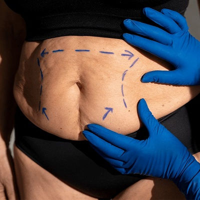 شفط الدهون بالليزر في عُمان