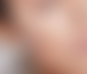 Can You Combine JUVÉDERM Voluma with Botox?