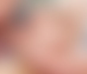 علاج حب الشباب للرؤوس السوداء والبيضاء