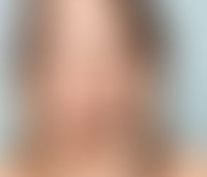 العلاج العميق لترهل الجلد: ما الذي يمكن توقعه