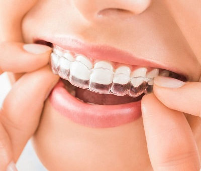 Overbite and Crowded Teeth: Treatment Solutions
