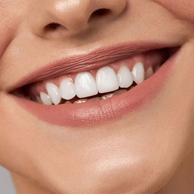 Best Teeth Whitening Dubai