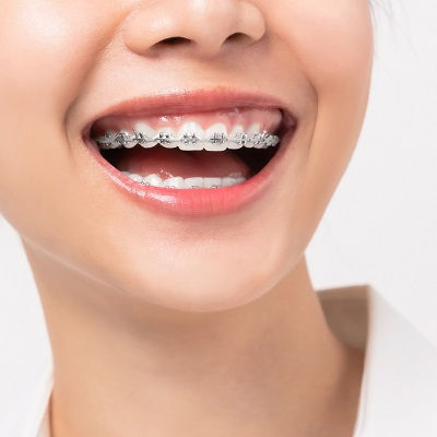 Metal Braces